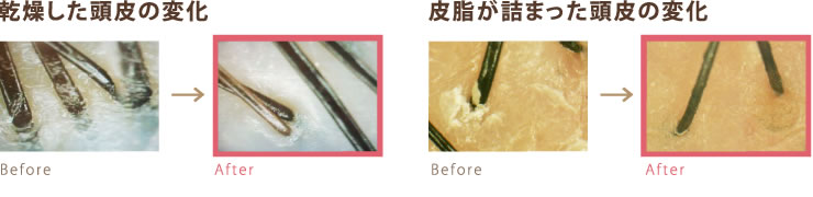 乾燥した頭皮の変化　皮脂が詰まった頭皮の変化